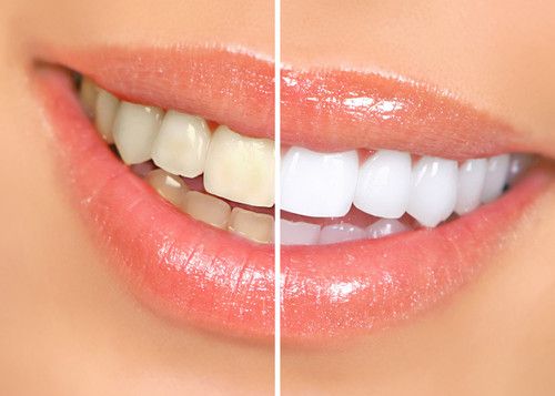 Bleaching Gigi Whitening