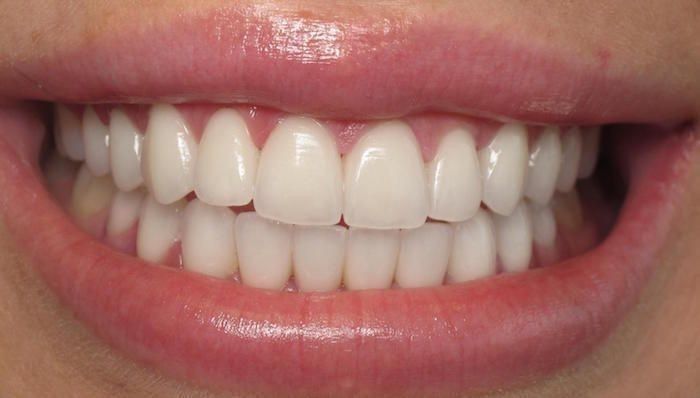 Veneer Gigi Premium